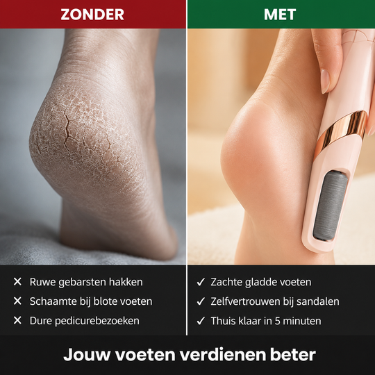 Elektrische Eeltverwijderaar – Voor zijdezachte voeten zonder salon